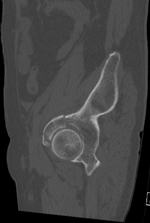 CT Becken sagittal