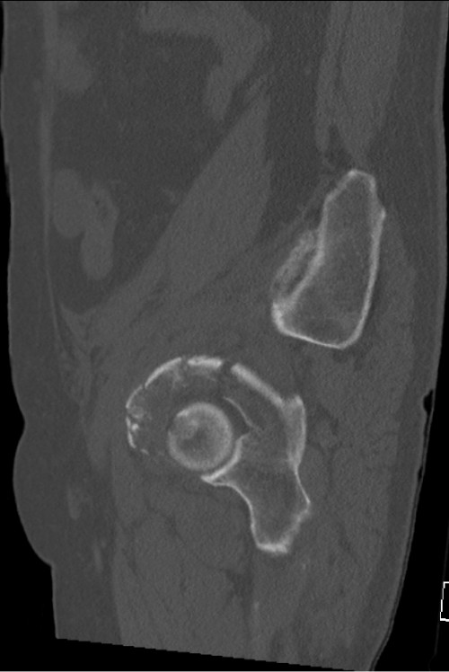 CT Becken sagittal