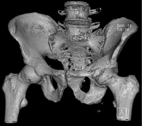CT Becken 3D Rekonstruktion