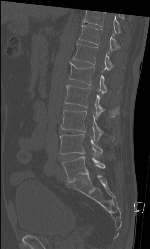 CT LWS sagittal