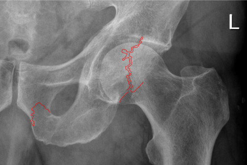 Acetabulum und Schambeinfrakturen