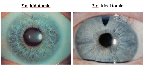 Iridotomie Iridektomie