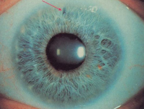 Iridotomie