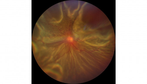 Totalablatio Fundus