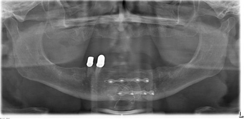 Bildgebung - OPAN postoperativ